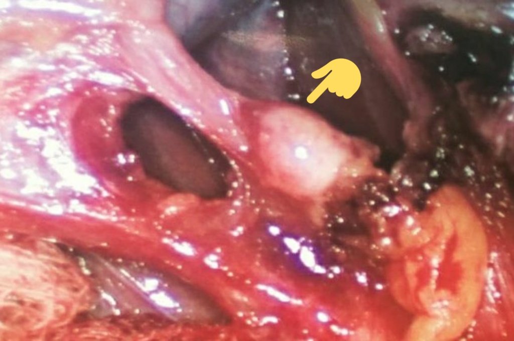 El ganglio de Lund, ganglio de Mascagni, o ganglio cístico, es el ganglio centinela de la vesícula. Crece en #colecistitis o #colangitis aguda. Su importancia radica en ser una referencia de seguridad y un dato estadificador en el #cáncer de vesícula. Mal llamado ganglio de Calot