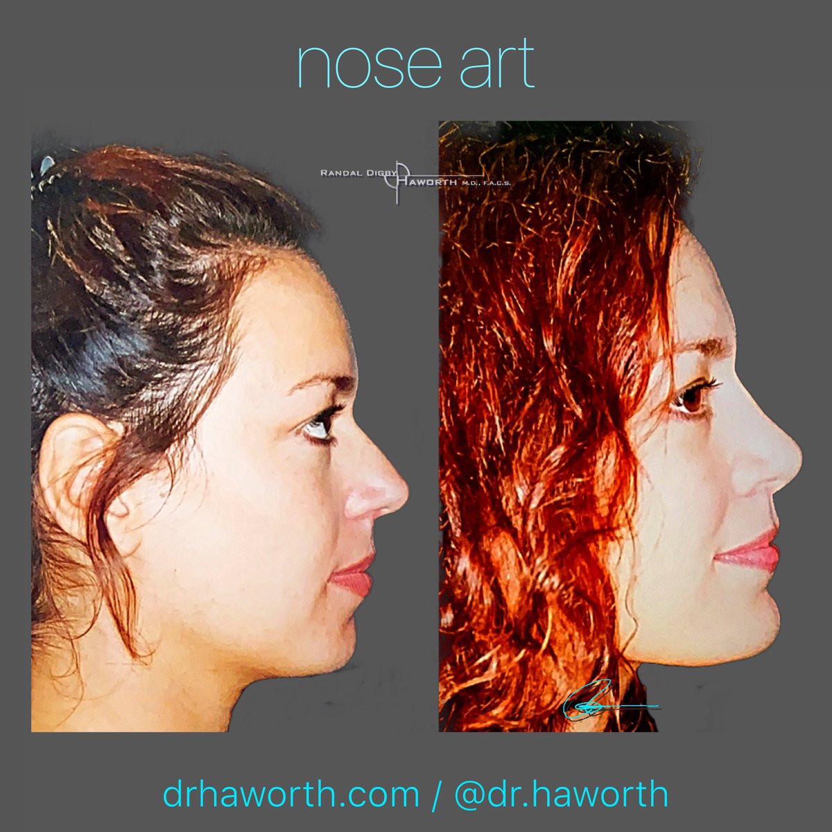 T͜͡b͜͡e͜͡ A͜͡r͜͡t͜͡ o͜͡f͜͡ N͜͡o͜͡s͜͡e͜͡
.
T̆̈h̆̈ĕ̈ n̆̈ŏ̈s̆̈ĕ̈ ĭ̈s̆̈ ĭ̈n̆̈ t̆̈h̆̈ĕ̈ c̆̈ĕ̈n̆̈t̆̈ĕ̈r̆̈ ŏ̈f̆̈ t̆̈h̆̈ĕ̈ f̆̈ă̈c̆̈ĕ̈ b̆̈ŭ̈t̆̈ ĭ̈t̆̈ s̆̈h̆̈ŏ̈ŭ̈l̆̈d̆̈ n̆̈ŏ̈t̆̈ d̆̈ŏ̈m̆̈ĭ̈n̆̈ă̈t̆̈ĕ̈ ĭ̈t̆̈!̆̈ #DrHaworth 

🌐 drhaworth.com