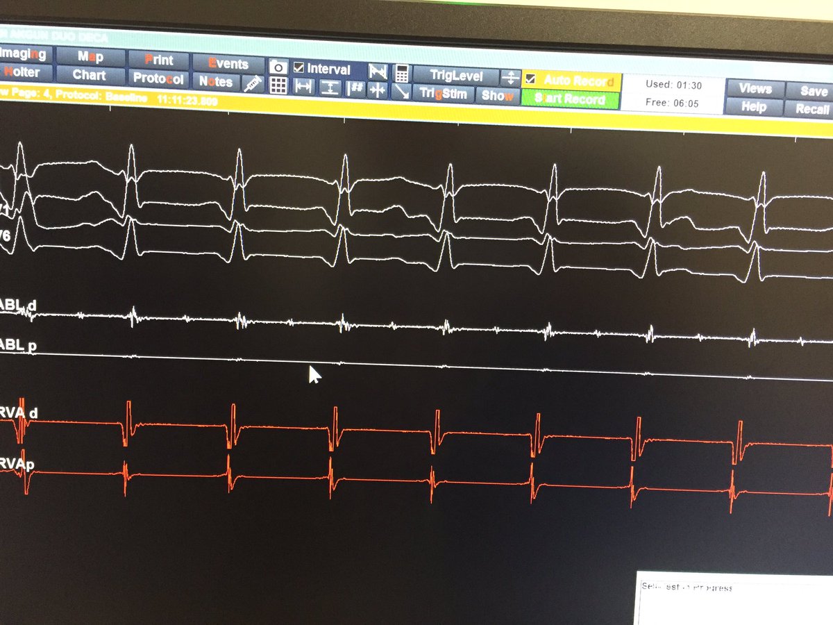 1. VT ecg 2. Abnormal potentials  showing decremental conduction 3. VT activation map /bipolar voltage map 4. Middiastolic potentials #ablateVT #EPeeps