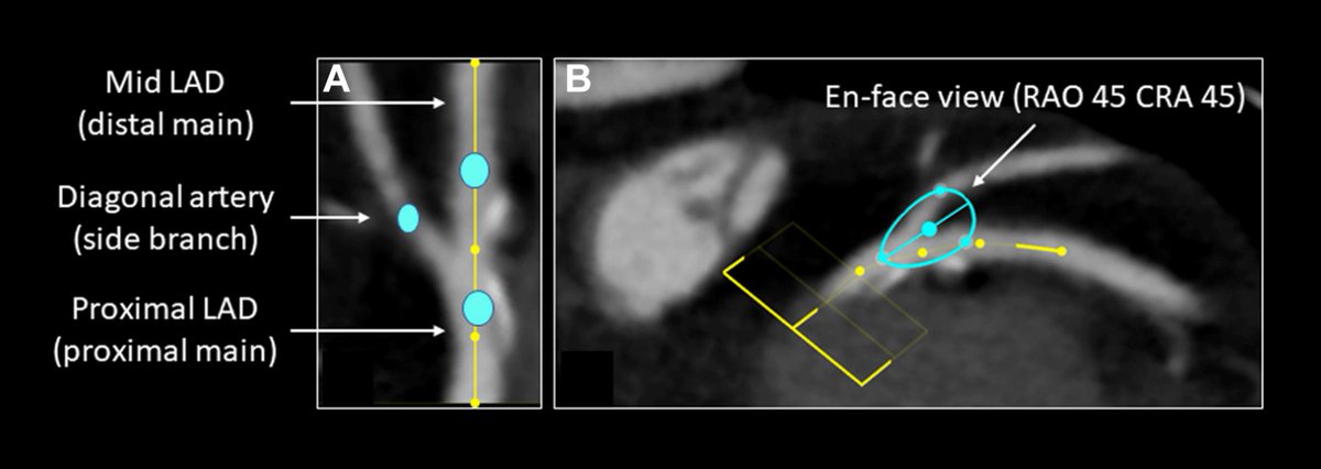 Must Read - 100 CT analysis On face Optimal Fluoroscopic Projections of Coronary Ostia and Bifurcations Defined by Computed Tomographic Coronary Angiography/ J Am Coll Cardiol Cardiovasc Interv. 2020 Nov, 13 (21) 2560–2570