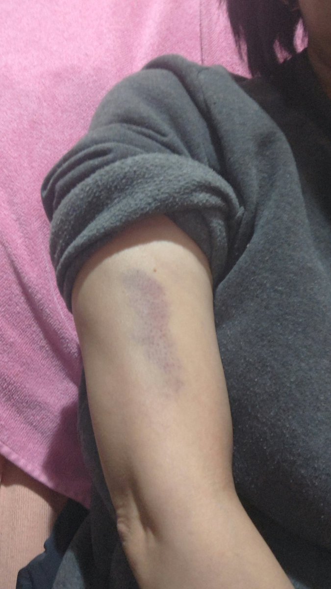 Mayさん 昨日旦那と数年ぶりに大喧嘩w 強く腕掴まれて今日痣になってて痛い Dv被害者みたいでワロスw つか内出血 毛穴見えてウケるんだけどwww Mayさん 昨日旦那と数年ぶりに大喧嘩w 強く腕掴まれて今日痣になってて痛い Dv被害者みたいでワロスw つか内出血 毛穴見えてウケるんだけどwww