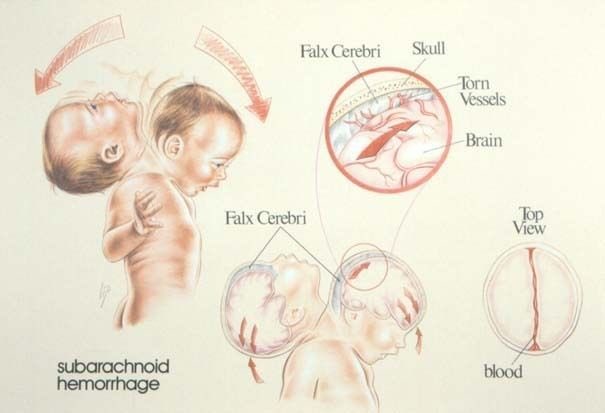 синдром тряски младенца. новорожденный ребенок трясет. новорожденный ребенок. новорожденный ребенок трясет. новорожденный ребенок трясет.