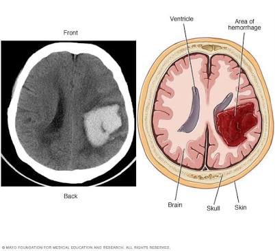 Инсульт геморрагический правая. Геморрагический инсульт головного мозга кт. Субарахноидальные кровоизлияния на мрт. Кортикальный геморрагический инсульт. Геморрагический инсульт с кровоизлиянием в головной мозг.