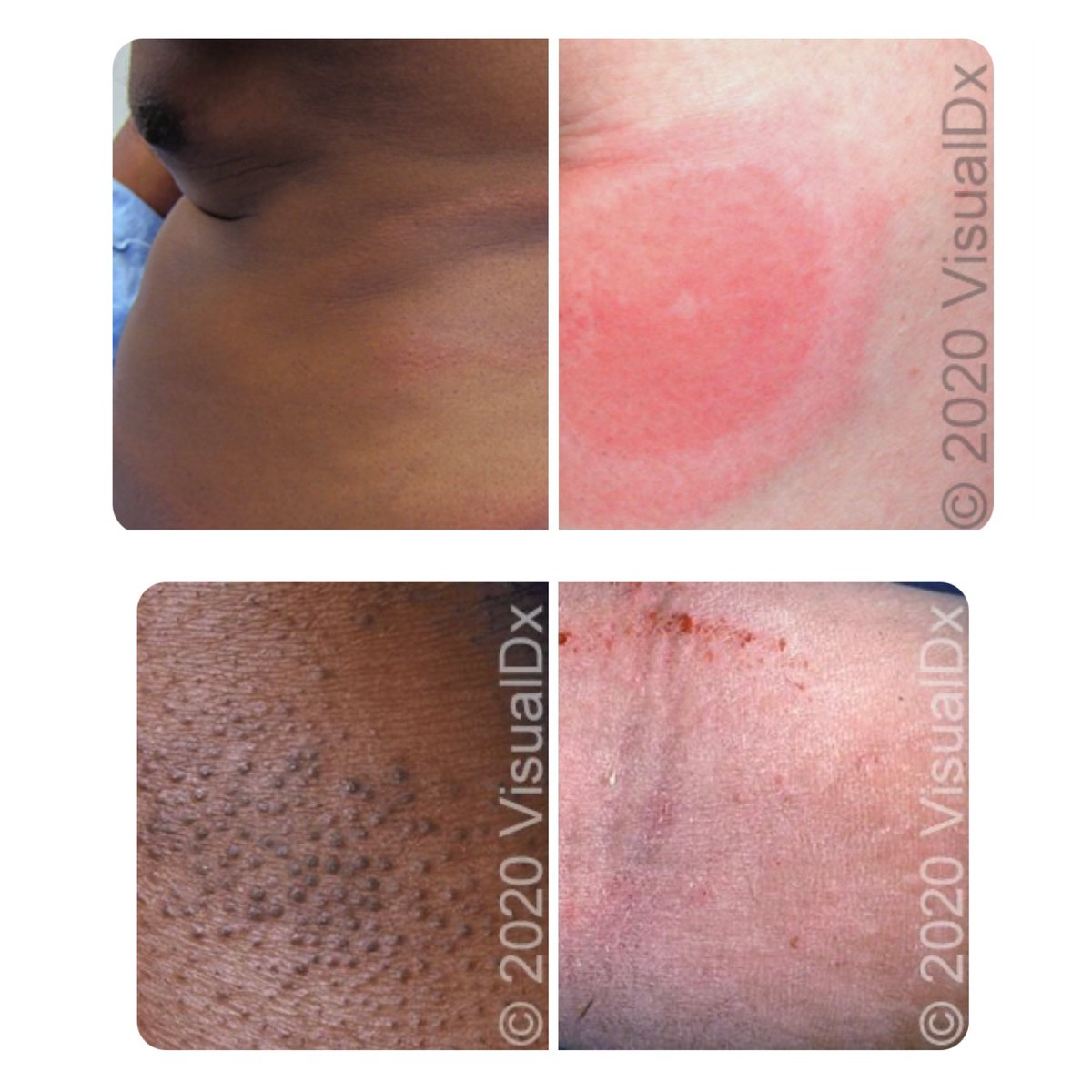 What do these represent? Learn about dermatologic findings in black & brown skin from Drs. Franco & Treat at the #virtual CHOP #InnovationsinPEM conference! Fostering #equityinhealthcare Sign-Up: chop.cloud-cme.com. @emresidents @ChildrensPhila #PEMCourseCHOP Pics: @VisualDx