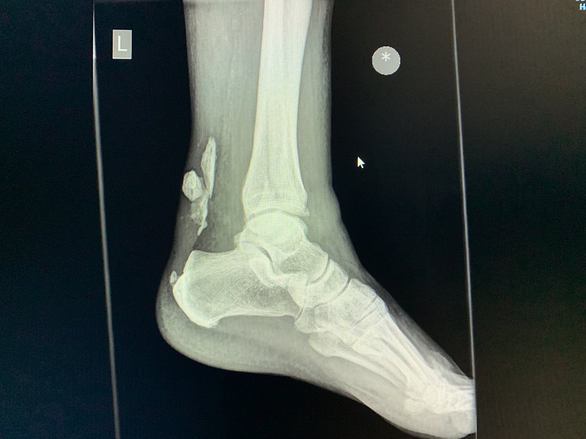 AdamMeakins's tweet photo. Few eccentrics should sort it... #Wowzers #CalcificAchilles 😳 https://t.co/4KRL76VLBU