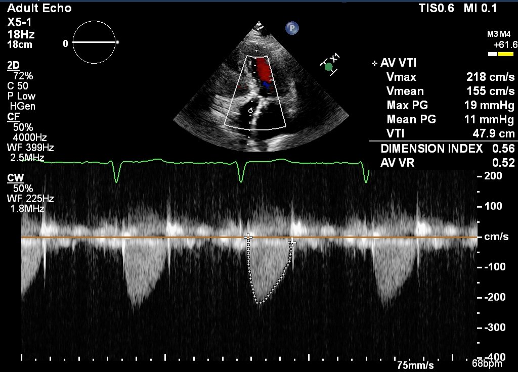Again, I suspect most of you will vote for TAVI in someone in their mid 80s...which is what patient had. This patient's post-procedure TTE is below with good outcome. What about next case though...
