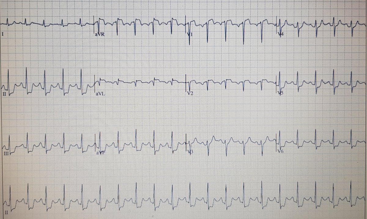 Treadmill test - finished 12mins Bruce protocol, no symptoms. Rest & peak stress ECGs below. LV images post stress showed cavity dilatation & slight fall in EF...so discussed at length at MDT meeting. V-in-V app suggests 26mm TAVI valve would be suitable if performed.