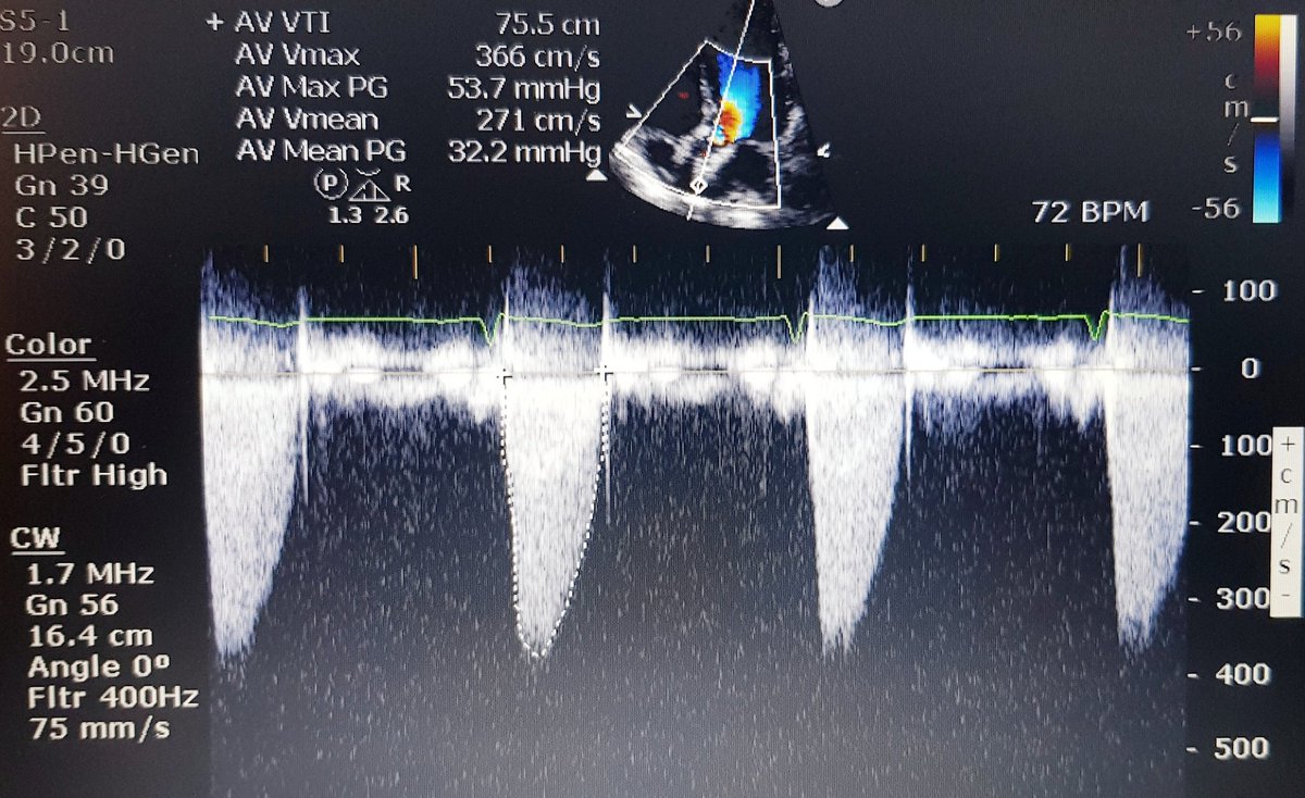 You may not agree, but in the end pt had V-in-V TAVI. Patient choice. Successful procedure.Here is pre-discharge TTE:6 months later patient feels fine, active and asymptomatic. But has AV Vmax 3.6-3.7m/s...in early 60s. How long will this last? Only time will tell!