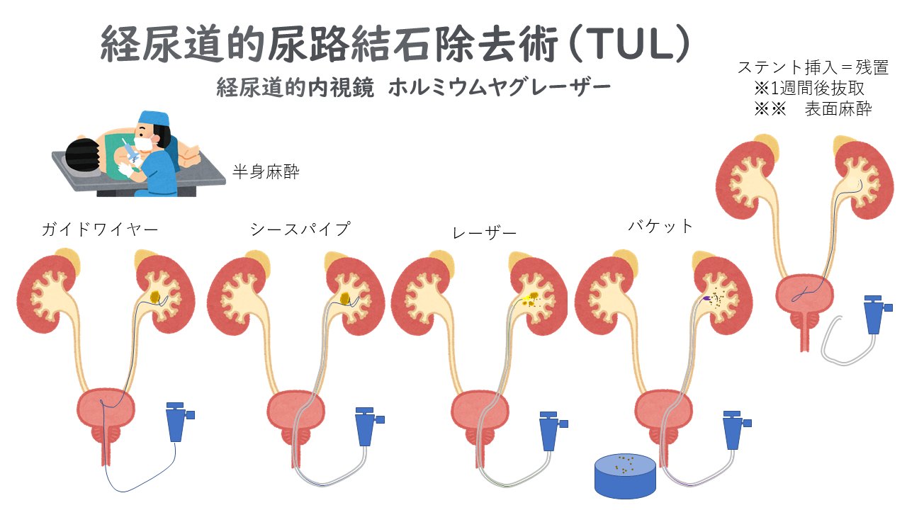 تويتر やまだはるひろ على تويتر 経尿道的尿路結石除去術 Tul 内視鏡を使った 腎臓結石のレーザー破砕手順 土曜日に ステントを抜いてもらう 検索したら 外資系の医療器具会社のイラストしかなかったので いらすとやさん の力を借りた T Co Qphu6srtbd