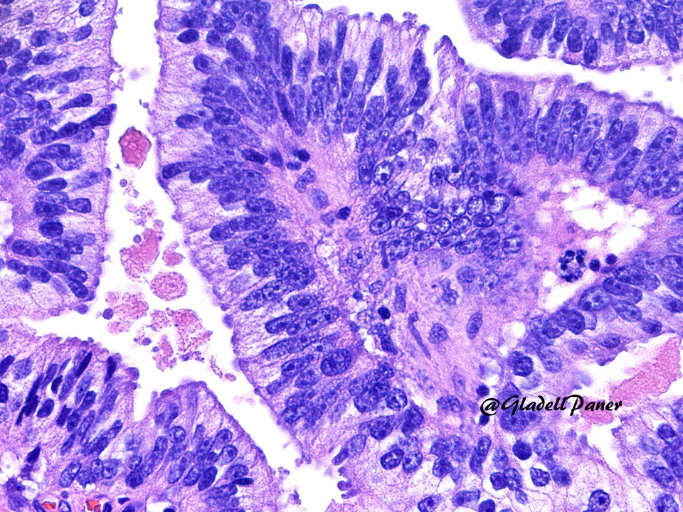 GladellPaner's tweet photo. 50s male with #UrinaryBladder mass TURBT. Answer in comment. #GrayZonePath 42 #GUPath https://t.co/Z9aQ5zIUSc