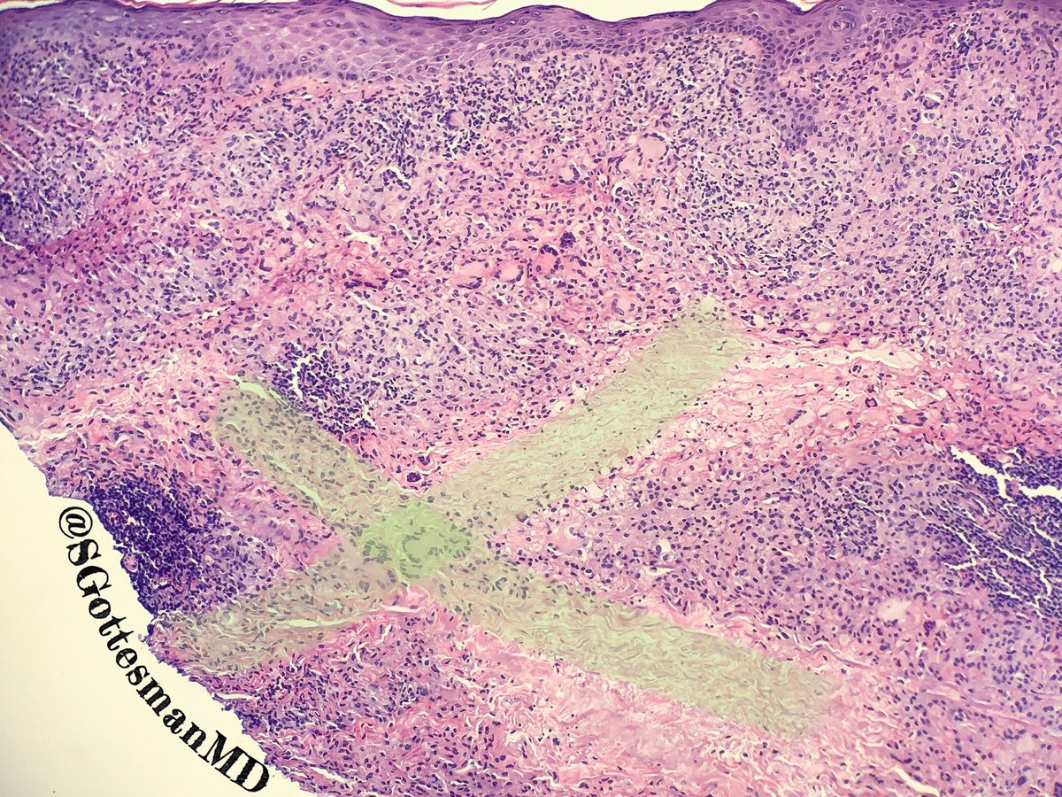 Silvija Gottesman MD on Twitter "RT SGottesmanMD Necrobiotic