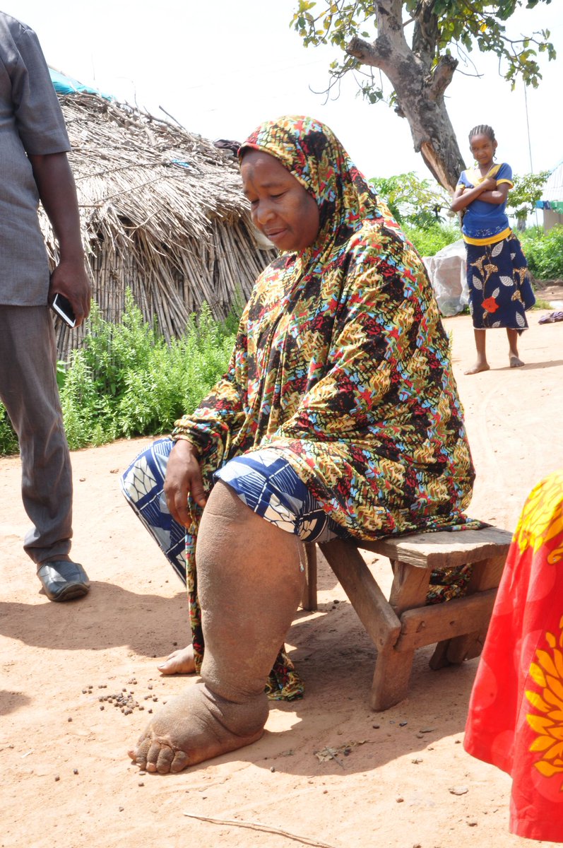 crownagents's tweet photo. The @WHO validated the elimination of #lymphaticfilariasis as a public health problem in #Malawi. A huge achievement
@health_malawi👏
As Malawi looks to the future, our #Ascend teams will support LF morbidity management and disability prevention associated with past infection https://t.co/GaSEpB5Ejb