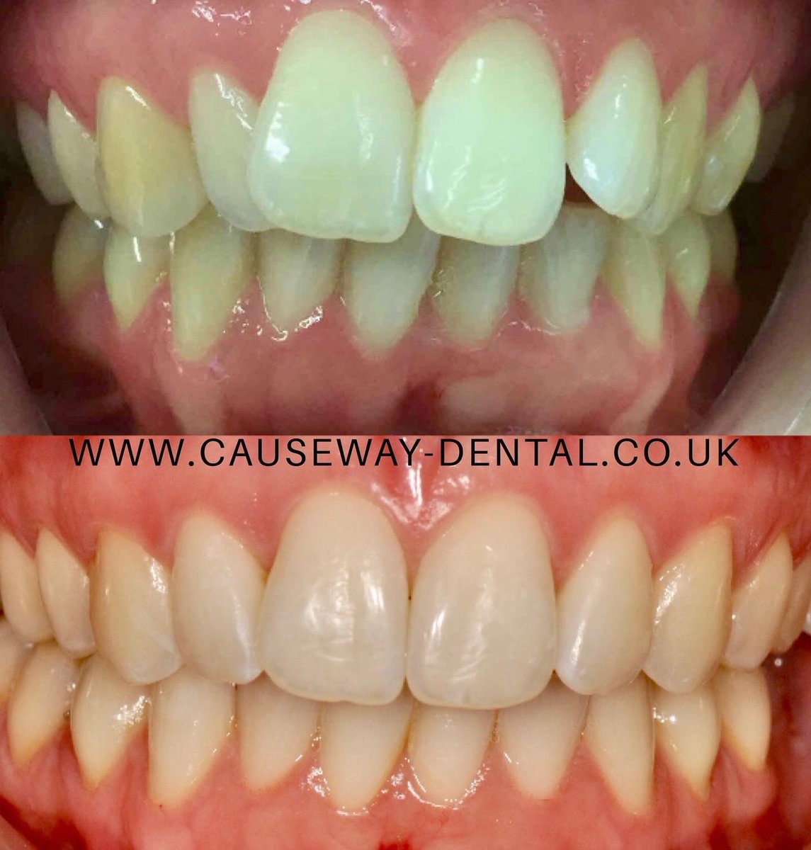 ⭐️INVISALIGN by Dr Sheetal Patel⭐️
📷 Before &amp; After photos 📸 
📞 For all Invisalign enquiries please call us on 01403 252477/ 01403 254615 #invisalign #straightteeth #teeth #results #horsham #crawley #westsussex #dental #dentalpractice #smile #smilemore