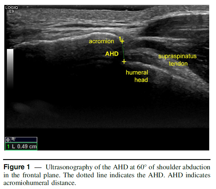PhysioMeScience's tweet photo. Is There a Decrease in the Acromiohumeral Distance Among Recreational Overhead Athletes With Rotator CuffโRelated Shoulder Pain?
๐๐๐๐
https://t.co/NEAKerPiBO https://t.co/takQICp57q