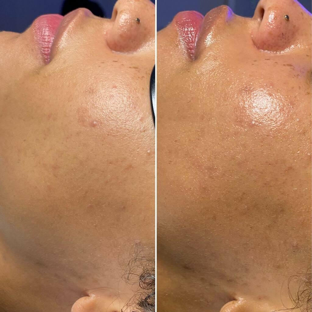 sabsrobinson's tweet photo. Can’t believe I had the privilege of giving a facial to of my favorite esti’s @yungfreckle Her skin was already perfection of course so I just added a little razzle dazzle.
.
.
.
.
#extractions #facials #enzymes #estheticianla #blackesthetician #pasaden… https://t.co/I3cVKDWsN5 https://t.co/r4IZ3rqyNf