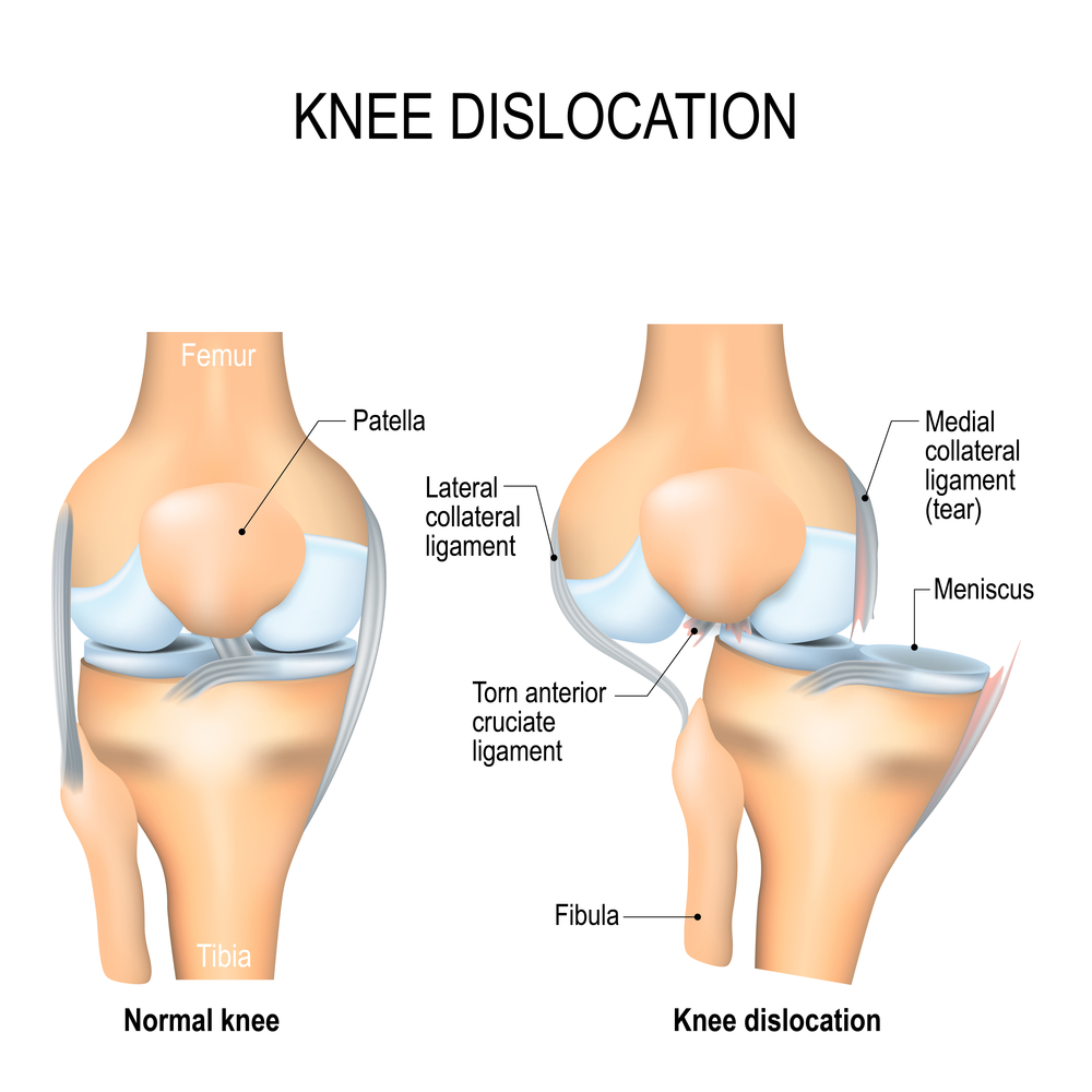 leslievidalmd's tweet image. Does #patellardislocation require surgery?

A dislocated kneecap is a fairly common injury among young athletes, and a first injury rarely requires kneecap stabilization surgery. medilink.us/5ej6  #kneedislocation