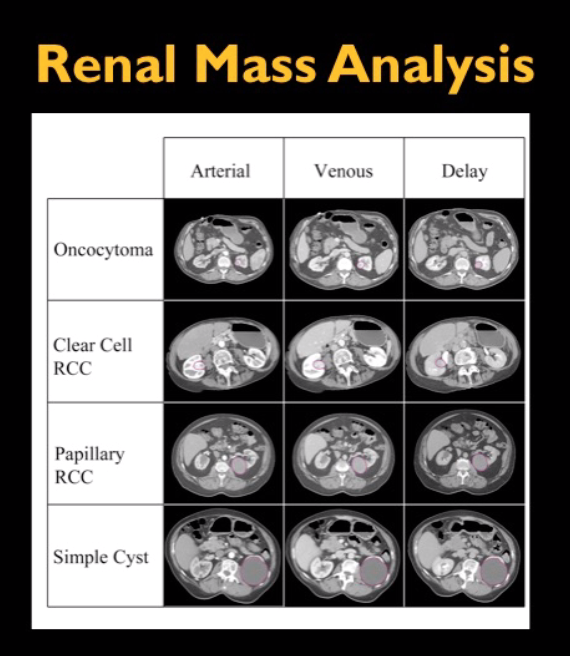 Renal Mass Analysis