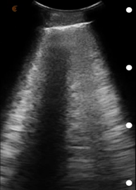 POCUSAcademy's tweet photo. ⚡November #POCUSCase ⚡ 
40 y/o male complains of fatigue, mild fever, dyspnea, dry cough, chest, &amp; muscle pain. Returned from overseas recently. Mild fever (99.6) and increased resp. rate, 30 breaths p/m. #POCUS image obtained, diagnosis? https://t.co/p2Xiorwx91 #POCUSforCOVID https://t.co/WuECplNv0K