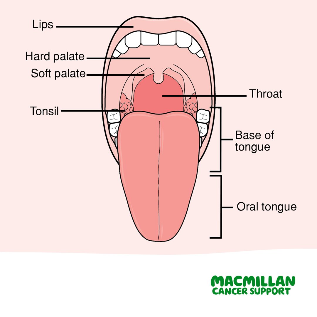 macmillancancer's tweet photo. It’s #MouthCancerAction month! Mouth cancer is one of the most common types of head and neck cancer. It can start in any part of the mouth. The most common symptom is an ulcer or sore that does not heal in three weeks. This may be in the mouth or on the lip. https://t.co/tpfaR4A0Tt
