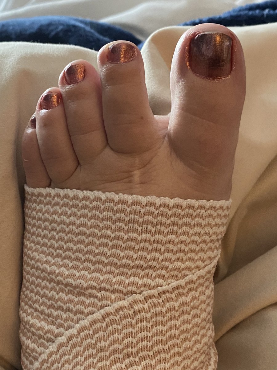 cozi2005's tweet photo. In 2006 I was diagnosed w CRPS in my left foot after a foot surgery gone awry. I now have it in my hips down both legs. It’s fitting on Sat night I fell in a hole, tweaked my left foot & flared my CRPS. Pain & chubby toes.
#CRPSORANGEDAY
#colortheworldorange
#BurningForACure https://t.co/Z7tPQLPqwu