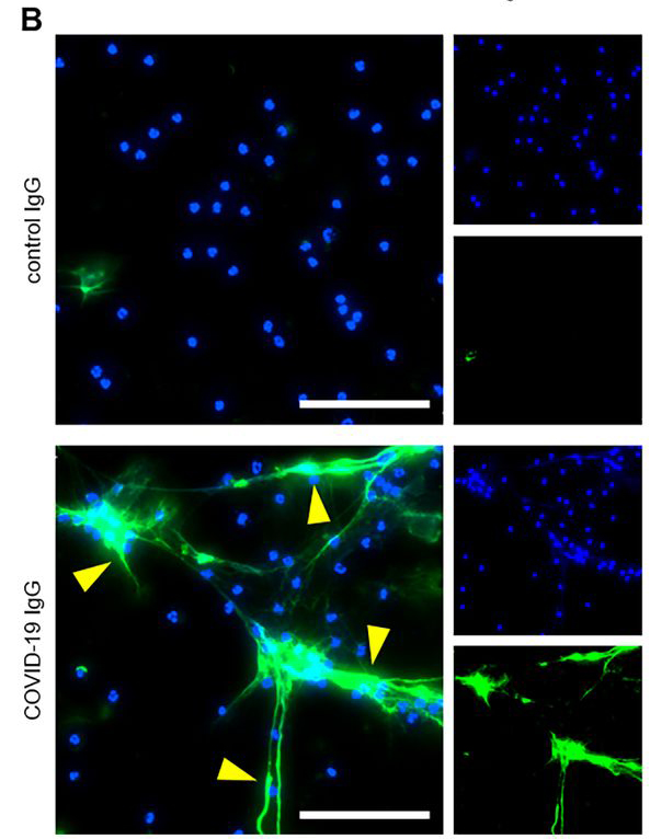 New: A <a href="/UMich/">University of Michigan</a>-led study of serum from 172 patients hospitalized with #COVID19 finds blood-clot-promoting autoantibodies in at least half of the samples, helping to explain why some patients experience increased clotting. fcld.ly/f4sgz8v