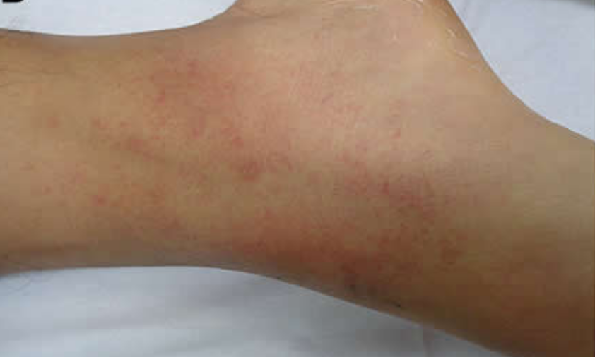  #idboardreview 25 M return from Venezuela 8d ago & 6d of F, HA, jaundice, N, V, 6 lb wtloss, dark urine. During travel walked barefoot in mud, hiked, swam, used mosquito repellent, no pre-travel medical advice. AST 14k, ALT 8k, Cr9, AP 250, Plt80, Bil7, diagnosis?  #medEd  #idmedEd