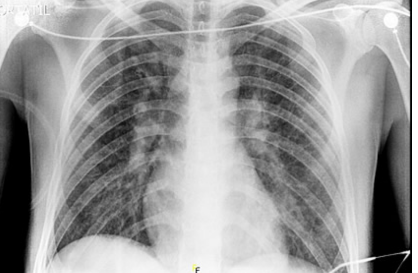  #idboardreview 25 M return from Venezuela 8d ago & 6d of F, HA, jaundice, N, V, 6 lb wtloss, dark urine. During travel walked barefoot in mud, hiked, swam, used mosquito repellent, no pre-travel medical advice. AST 14k, ALT 8k, Cr9, AP 250, Plt80, Bil7, diagnosis?  #medEd  #idmedEd