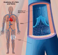 Chronic venous insufficiency occurs when your leg veins don’t allow blood to flow back up to your heart. Normally, the valves in your veins make sure that blood flows toward your heart. But when these valves don’t work well, blood can also flow backwards. This can cause edema.