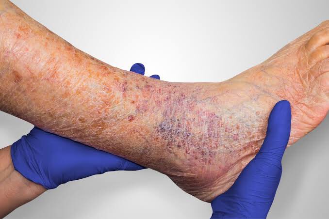 Symptoms of chronic venous insufficiency may include:Swelling in your legs or anklesTight feeling in your calves or itchy, painful legsPain when walking that stops when you restBrown-colored skin, often near the anklesVaricose veinsLeg ulcers