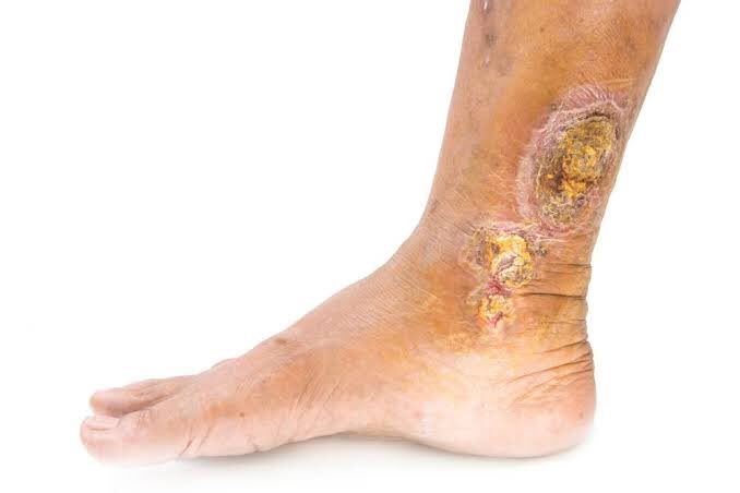 Symptoms of chronic venous insufficiency may include:Swelling in your legs or anklesTight feeling in your calves or itchy, painful legsPain when walking that stops when you restBrown-colored skin, often near the anklesVaricose veinsLeg ulcers