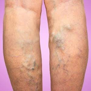 Varicose veins