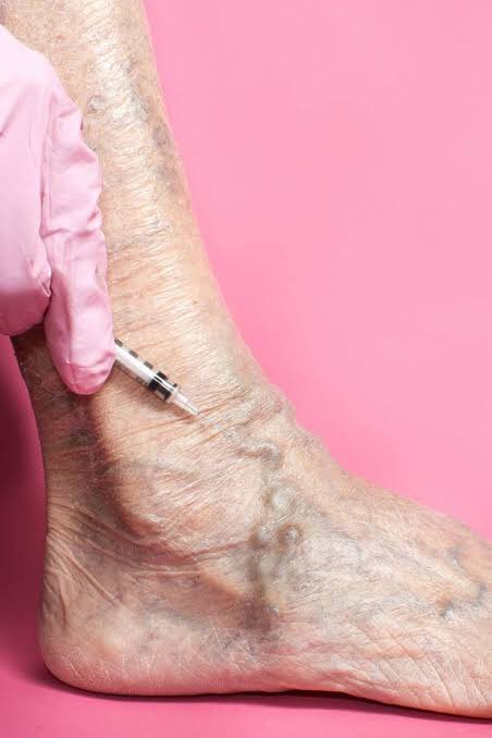 Sclerotherapy. This may be used if your case is more serious. A chemical is injected into the affected veins. The chemical causes scarring in the veins so that they can no longer carry blood. Blood then returns to the heart through other veins. The body absorbs the scarred veins.