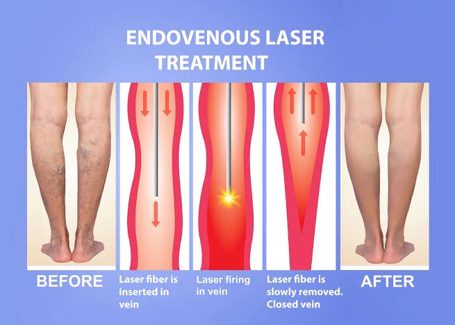 Endovenous laser ablation or radiofrequency ablation (RFA). This is a minimally invasive procedure. A tube (catheter) puts heat right into the affected vein. This closes the vein. Once the vein is closed, less blood pools in the leg. Overall blood flow is improved.
