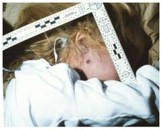 En agosto de 1997, se establece que JonBenét falleció como consecuencia de un golpe muy fuerte en uno de los costados de su cabeza, el cual le causó una fractura grave. Por otro lado, el doctor Richard Krugman, especialista en abuso infantil, dijo que había una abrasión vaginal