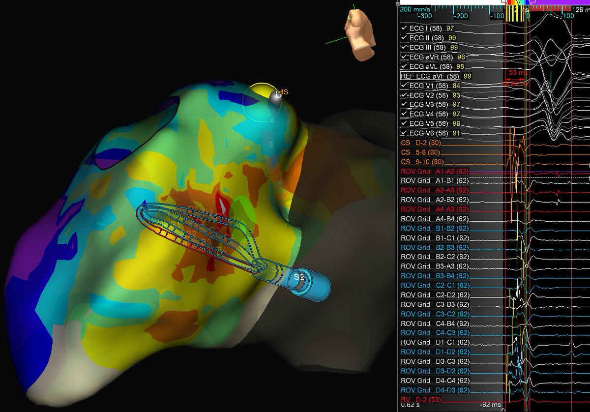 53 ms ahead.. looking good! 
Automap with 98% Score and #HDGrid 
<a href="/AbbottCardio/">Abbott Cardiovascular</a>