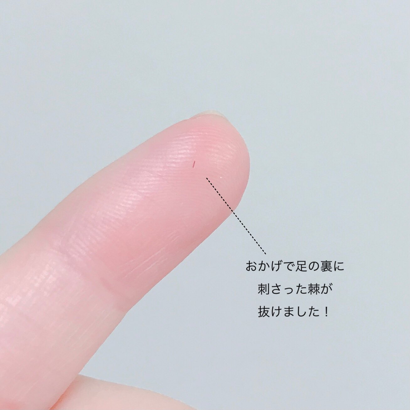 Twitter 上的 一藤 トゲが刺さったときは患部に5円玉の穴を強く押し当てよう トゲ が浮き出たらピンセットでエイよ って情報流してくれた警視庁ありがとう お陰で足の裏に刺さったトゲが抜きやすくなりました あとファンケルの毛抜きもありがとう 小さいトゲも一発