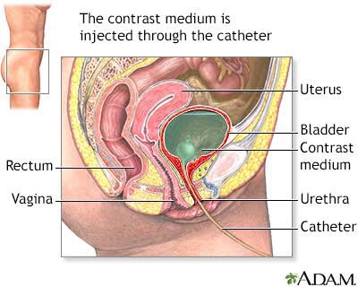 StudentRTCU's tweet photo. Voiding cystourethrography (VCUG) เป็นการตรวจด้วย fluoroscopy ของ lower urinary tract ซึ่งมีการใส่ contrast ผ่านสายสวน (Catheter) เข้าไปในกระเพาะปัสสาวะ จุดประสงค์เพื่อประเมิน กระเพาะปัสสาวะ ท่อไต หรือ การไหลย้อนของน้ำปัสสาวะเข้าท่อไต (Vesicoureteric reflux : VUR) #รังสีเทคนิค 1/ https://t.co/U9C1YJ3G7b