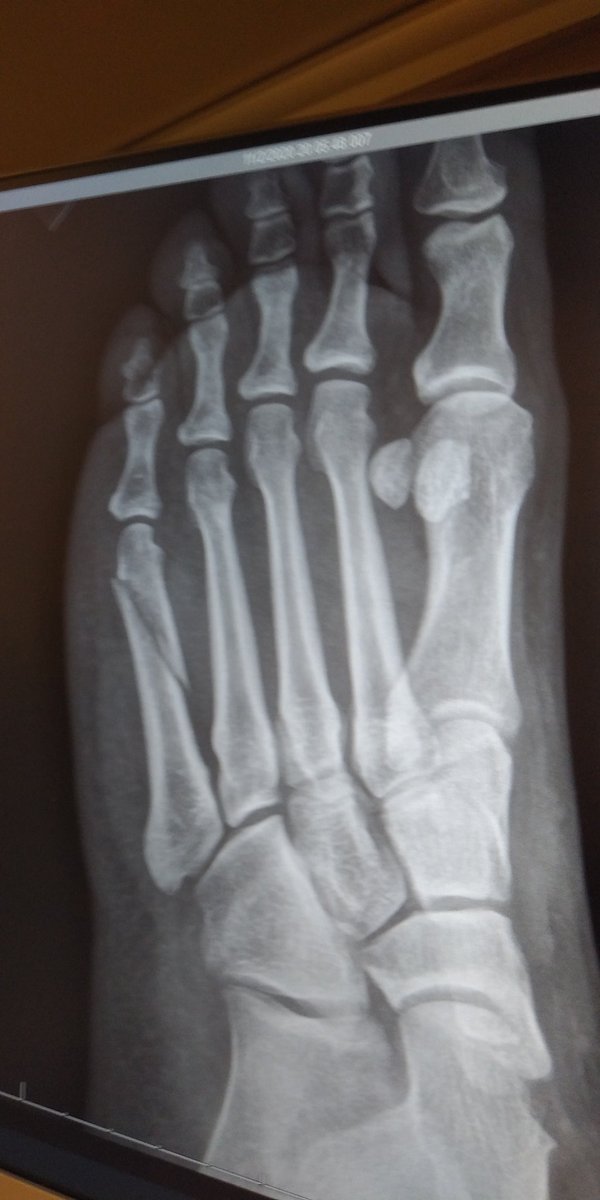 EvilAngel1679's tweet photo. Missed the last step.... Broke my foot #gottheboot https://t.co/BLgXlz4iJE