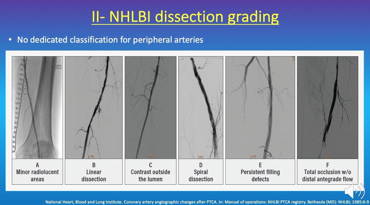 HadyLichaaMD's tweet photo. #Subintimal vs #Intraluminal #endovascular #crossing of #peripheral #CTO? Which approach is better?
https://t.co/rwQ5HF68zD
@SriniTummala @EricSecemskyMD @JayMathewsMD @FadiSaab17 @RajTayalMD @Mustapja @ekgpdx @ashkan_1670 @Umair2017 @mirvatalasnag @ShariqShamimMD @TimYatesMD https://t.co/HMkTAX7rYs