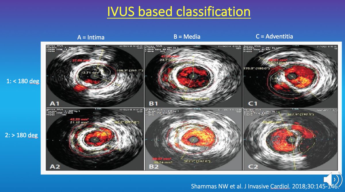 HadyLichaaMD's tweet photo. #Subintimal vs #Intraluminal #endovascular #crossing of #peripheral #CTO? Which approach is better?
https://t.co/rwQ5HF68zD
@SriniTummala @EricSecemskyMD @JayMathewsMD @FadiSaab17 @RajTayalMD @Mustapja @ekgpdx @ashkan_1670 @Umair2017 @mirvatalasnag @ShariqShamimMD @TimYatesMD https://t.co/HMkTAX7rYs