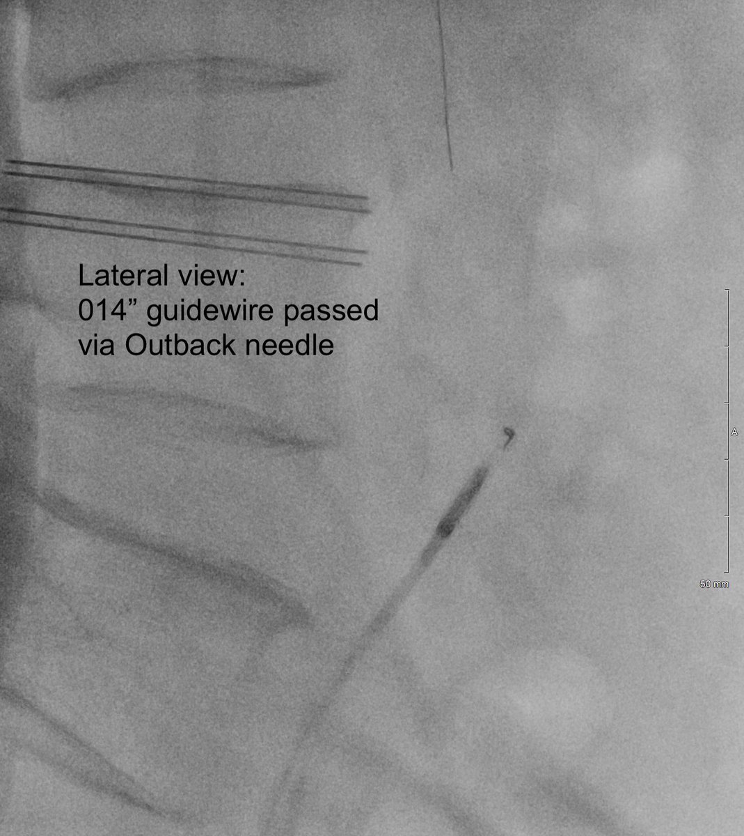 michaeldburns's tweet photo. Am liking the Outback re-entry device. Severe claudication due to right CIA and EIA #CTO. Retrograde subintimal recanalization with re-entry at CIA origin on first needle pass.
#irad #iliac #minimallyinvasive
@CAIRweb @SIR_ECS https://t.co/eNFmnYpzw2