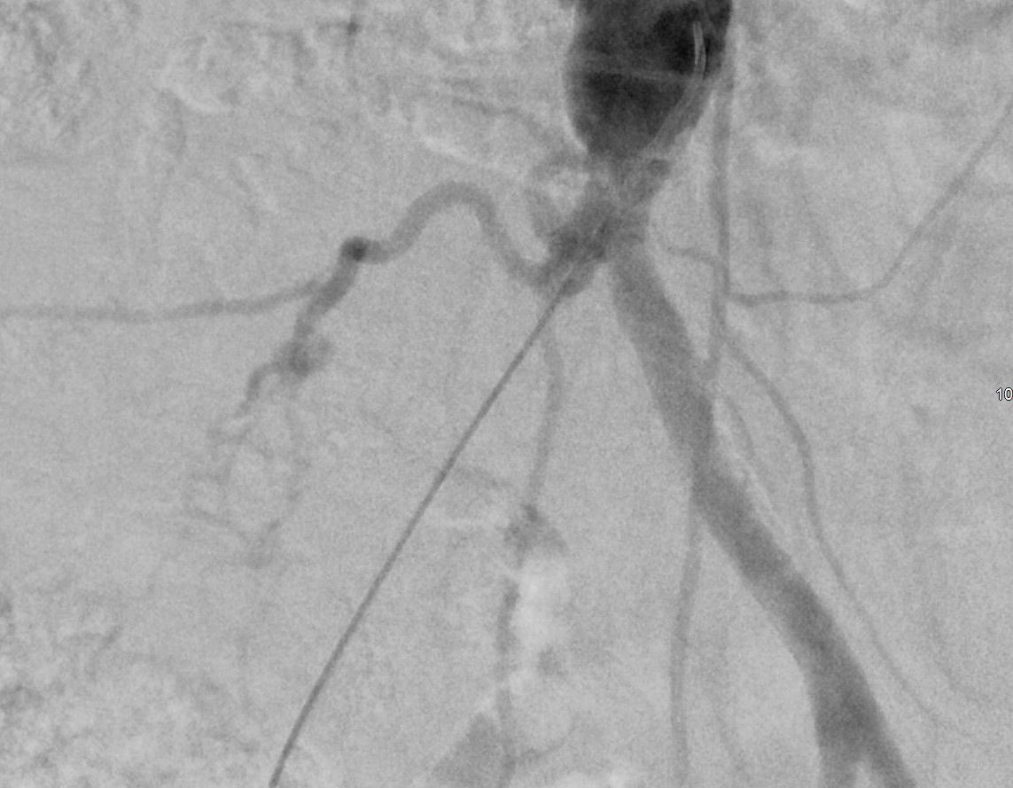michaeldburns's tweet photo. Am liking the Outback re-entry device. Severe claudication due to right CIA and EIA #CTO. Retrograde subintimal recanalization with re-entry at CIA origin on first needle pass.
#irad #iliac #minimallyinvasive
@CAIRweb @SIR_ECS https://t.co/eNFmnYpzw2
