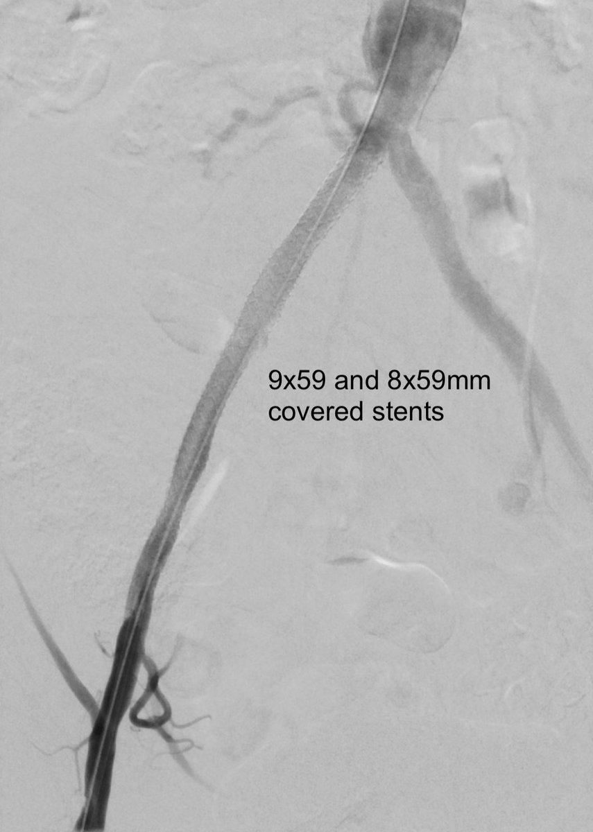 michaeldburns's tweet photo. Am liking the Outback re-entry device. Severe claudication due to right CIA and EIA #CTO. Retrograde subintimal recanalization with re-entry at CIA origin on first needle pass.
#irad #iliac #minimallyinvasive
@CAIRweb @SIR_ECS https://t.co/eNFmnYpzw2