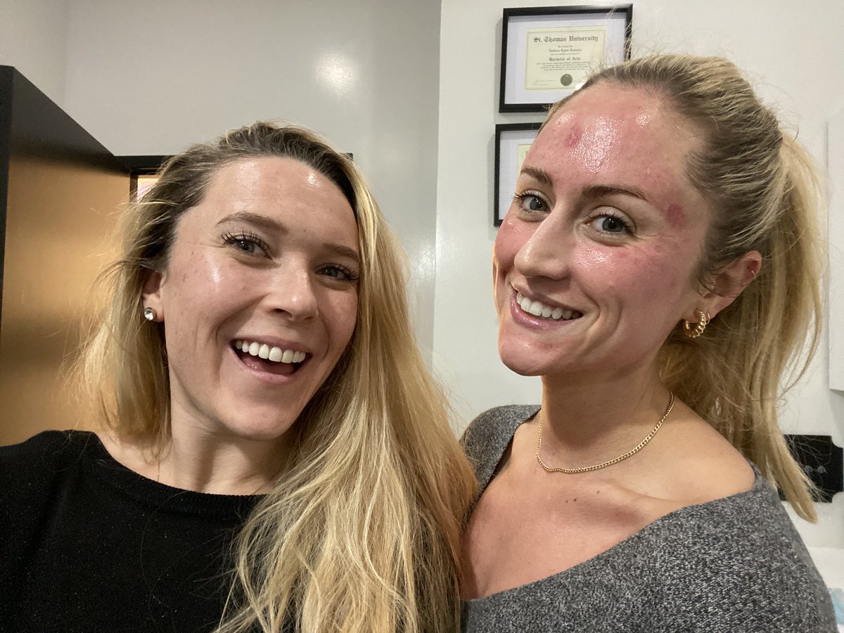 This is what it looks like when you try new skincare treatments! #microneedling #photorejuvenation #vibemedispa