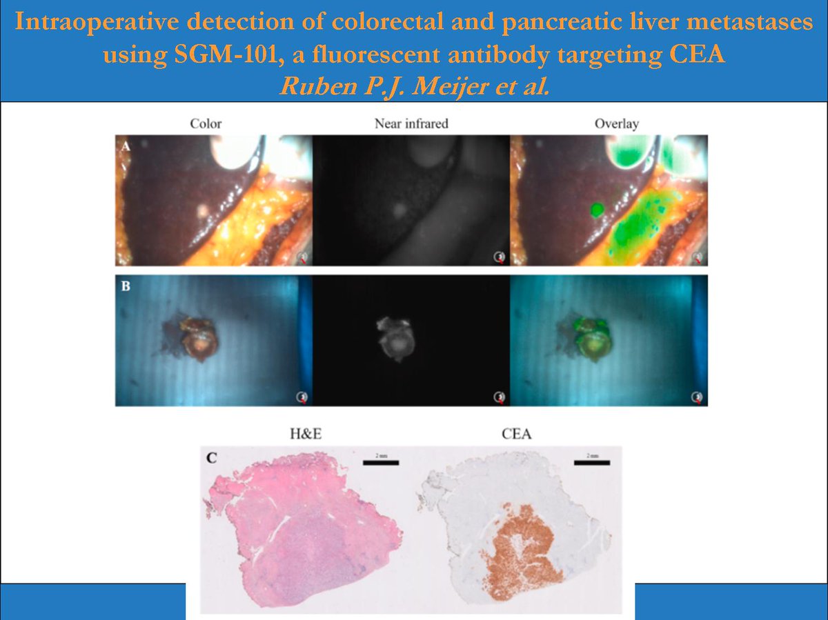 European Journal of Surgical Oncology (@ejsotweets) on Twitter photo Intraoperative detection of colorectal and pancreatic liver metastases using SGM-101, a fluorescent antibody targeting CEA <a href="/LUMC_Leiden/">LUMC Leiden</a> <a href="/CHDR_NL/">CHDR</a>
<a href="/ESSOnews/">European Society of Surgical Oncology (ESSO)</a> <a href="/OncologyAdvance/">Oncology Advance</a> <a href="/isfgs/">ISFGS</a> <a href="/ManishChandSurg/">Manish Chand FRCS PhD MBA</a> <a href="/hpb_so/">SoMe4HPB</a> <a href="/me4_so/">SoMe4Surgery</a> <a href="/juliomayol/">Julio Mayol</a>
#SurgOnc #HPB #Fluorescence
bit.ly/2TPVd6A Intraoperative detection of colorectal and pancreatic liver metastases using SGM-101, a fluorescent antibody targeting CEA <a href="/LUMC_Leiden/">LUMC Leiden</a> <a href="/CHDR_NL/">CHDR</a>
<a href="/ESSOnews/">European Society of Surgical Oncology (ESSO)</a> <a href="/OncologyAdvance/">Oncology Advance</a> <a href="/isfgs/">ISFGS</a> <a href="/ManishChandSurg/">Manish Chand FRCS PhD MBA</a> <a href="/hpb_so/">SoMe4HPB</a> <a href="/me4_so/">SoMe4Surgery</a> <a href="/juliomayol/">Julio Mayol</a>
#SurgOnc #HPB #Fluorescence
bit.ly/2TPVd6A