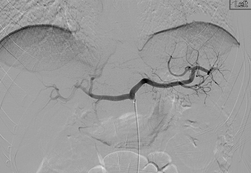 urmed_ir's tweet photo. 30 year old male with a #splenic lac. No extrav on the #angio, prophylactic proximal coil embo, with some collateral flow to the spleen. #Irad #TwittIR #InnovationToHeal #Radiology #Interventional #TraumaIR https://t.co/fWIwkrh42x