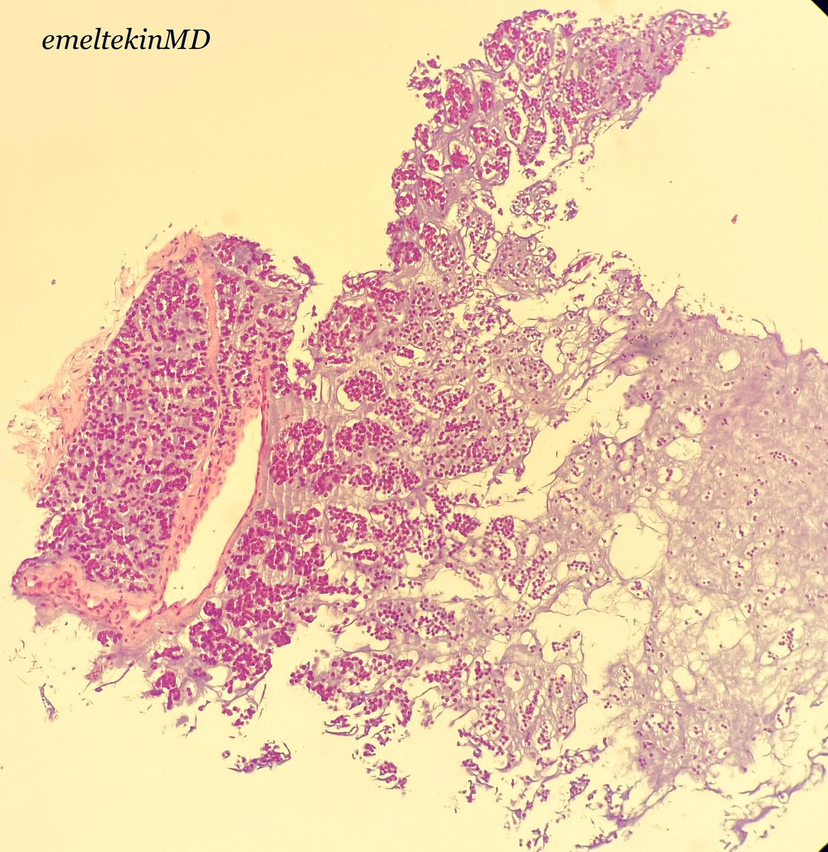 emeltekinMD's tweet photo. 56 year old/ male/ distal femur/ intramedullary and soft tissue mass/ radiologically malign/ what is your diagnosis? #bonepath #softpath #pathology #PathTwitter https://t.co/VFPfn5qEhV