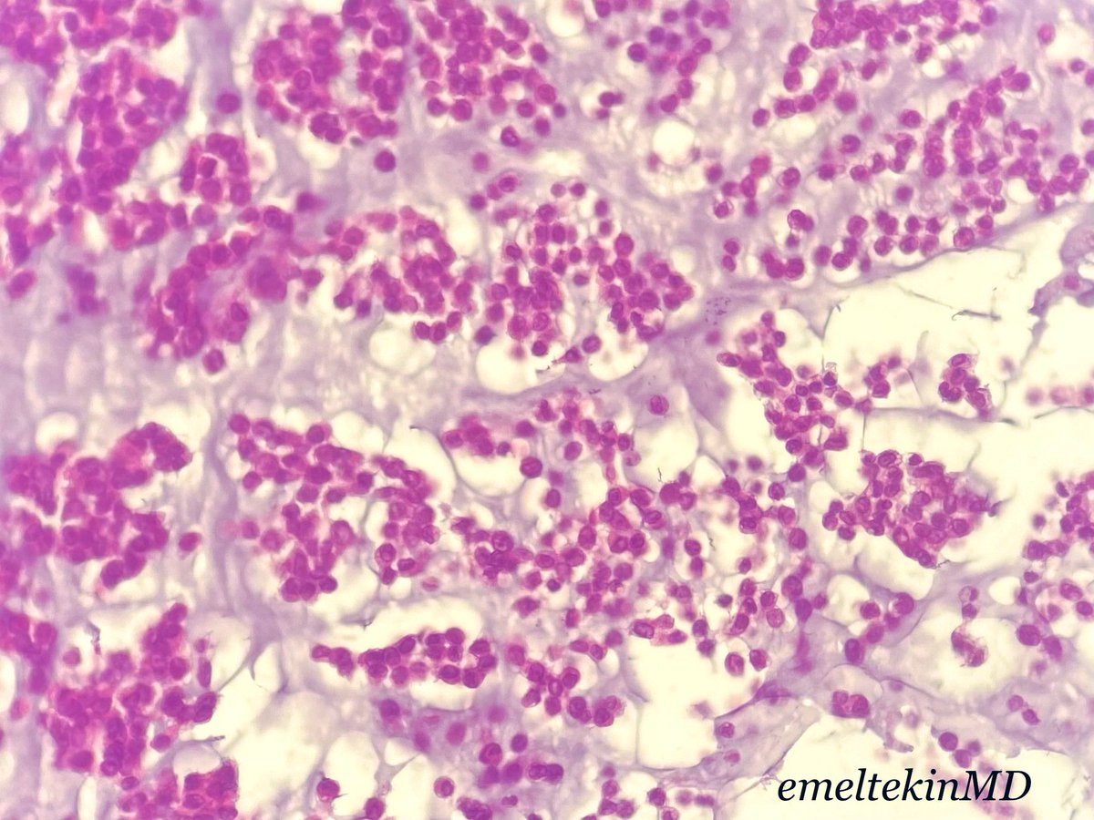 emeltekinMD's tweet photo. 56 year old/ male/ distal femur/ intramedullary and soft tissue mass/ radiologically malign/ what is your diagnosis? #bonepath #softpath #pathology #PathTwitter https://t.co/VFPfn5qEhV