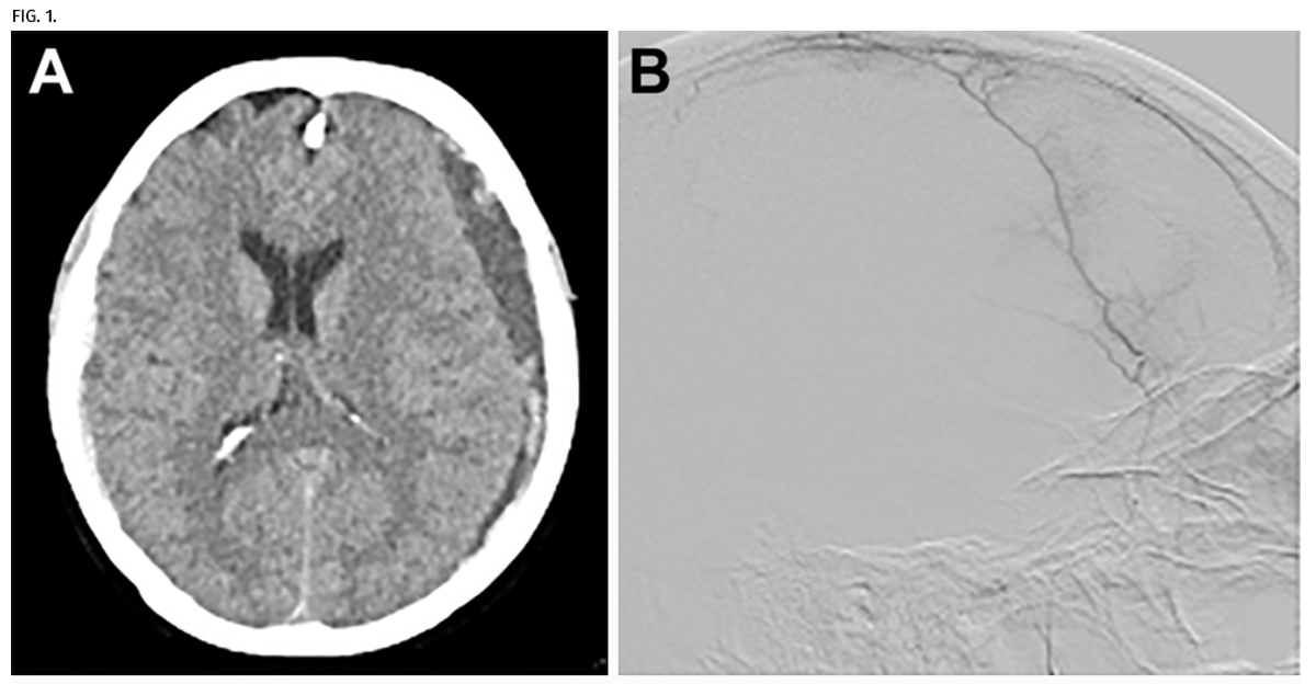 #NeurosurgicalFocus Middle meningeal artery embolization treatment of nonacute subdural hematomas in the elderly: a multiinstitutional experience of 151 cases thejns.org/focus/view/jou…