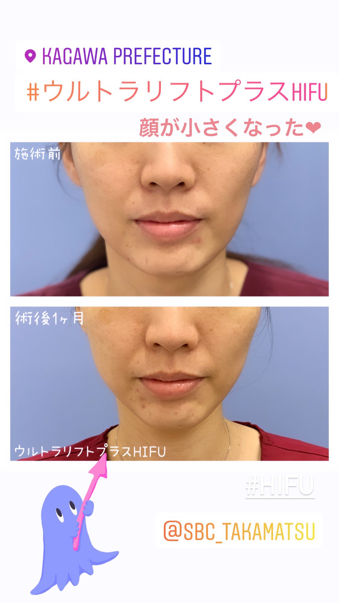 コラーゲンリフト　4箱　36000円 コラーゲンリフト 4箱 36000円